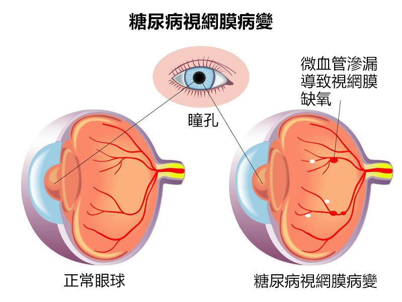 糖尿眼| 糖尿上眼| 成因症狀| 治療手術- 香港激光矯視中心